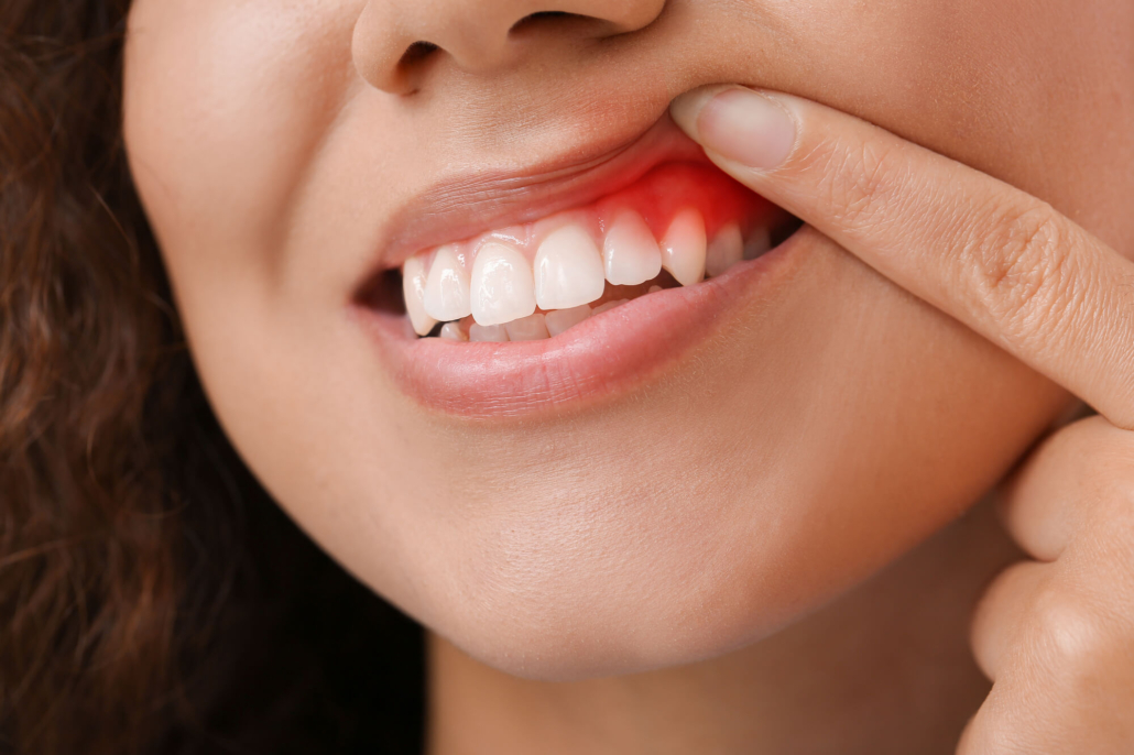 gums